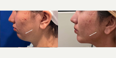 Woman treated with Chin Implant - FACIAL BALANCE Genioplasty aka Chin shaping in this case by Chin Implant About 1 month post-op Her profile is much more balanced and looking snatched!