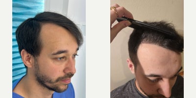 25-34 year old man treated with DHI Hair Transplant - 6 months post hair transplant approximately 40% of the final resultThis result is shown 6 months after the procedure, which represents an early growth phase and approximately 40% of the final expected outcome. At this stage, transplanted hair is still maturing density, thickness, and overall texture will continue to improve over the next several months.The photos present the frontal area and temporal zones, with additional views from the side profile, allowing for an objective assessment of hairline design, direction, and early density.Final results are typically evaluated between 12 and 15 months after the procedure, once full hair maturation is complete.