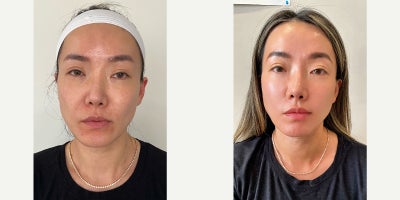 25-34 year old woman treated with Botox, Dermal Fillers, VI Peel, HydraFacial - A full-face refresh designed to smooth, hydrate, and illuminate. This client received botox for natural muscle relaxation, clinical MD precision filler placement for balanced contour and volume restoration, a HydraFacial to deeply cleanse and hydrate, and a series of Vi Peel to refine tone and texture. The result is skin that is firmer, clearer, and more luminous all while maintaining natural facial structure and expression.