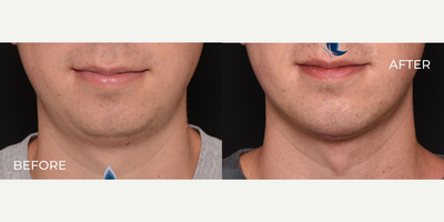 Man treated with Chin Implant - Man treated with Chin Implant