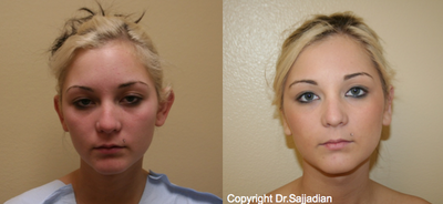 Ear Surgery - Otoplasty