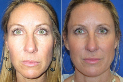 35-44 year old woman treated with Injectable Fillers - This patient came in wanting to discuss natural-looking treatments for facial rejuvenation. After consulting with Dr. Ho about options for collagen stimulation the patient elected to have a sculptra treatment series.