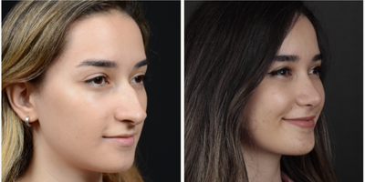 18-24 year old woman treated with Rhinoplasty - nasal shape deformity fixed by open ultrasonic rhinoplasty