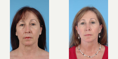 52 year old woman treated with Cheek Lift - A 52 year old woman before and after Limited Incision Cheek and Neck Lift with Quad Blepharoplasty by Andrew Lyos M.D FACS.