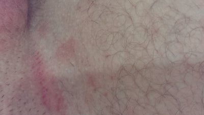 red lines on butt