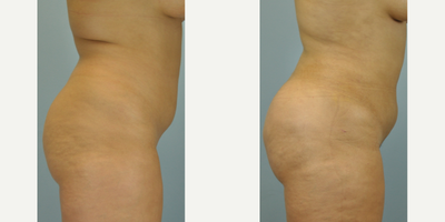 23 year old woman treated with Brazilian Butt Lift - This 23 year old elected to have Brazillian Butt Lift, with her own autologous fat transferred from Vaser liposelection of her abdomen, flanks, and back during the same surgery.