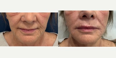 65-74 year old woman treated with Lip Fillers, Dermal Fillers, Volbella - This patient desired more plump and hydrated lip appearance.  1cc of Juvederm Volbella dermal filler was used to achieve a more defined and fuller lip appearance.She also underwent injections of Bellafill long-lasting dermal filler and Evolysse HA filler to the jowls, nasolabial folds and marionette lines to create a more youthful lower face appearance.