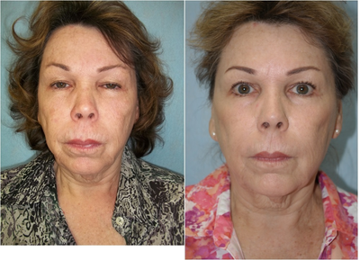 InMode Fractora to Face and Neck - Two treatments 1st to neck only with 24 and 60 pin tips at 50 mj; 2nd 2 months later to face with 24 and 60 pins tips at 45 mj2 full passes stacked, patient 63 years old For skin resurfacing, fine lines, and wrinkles on the face and neck