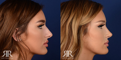 Rhinoplasty - Rhinoplasty