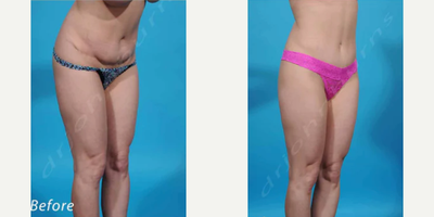 Woman treated with Liposuction Revision - Woman treated with Liposuction Revisionto flanks as well as Tummy Tuck Revisionwithlowered incision below panty line and Belly ButtonRevision.