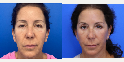 55-64 year old woman treated with Eyelid Surgery - 57 year old patient 4 months after a Facelift, Neck lift, Upper and lower eyelid blepharoplasty, facial fat transfer and co2 laser.