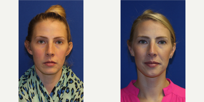 25-34 year old woman treated with Ear Surgery - This is a 31 year old patient who underwent cosmetic rhinoplasty and otoplasty procedure. She was bothered by the hump on her nose and protruding ears, but she was afraid of the operated nose. The result she achieved is a very natural and subtle changes to the nose and ears.