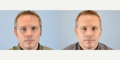 37 year old man treated with Restylane - This patient was treated with Restylane and Juvederm.