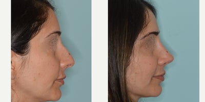 35-44 year old woman treated with Rhinoplasty - Before and after primary rhinoplasty for a patient with a challenging case of a crooked nose and dorsal hump. Techniques to straighten the crooked nose included medial and lateral osteotomies, ultrasonic rhinoplasty hump reduction, clocking sutures, and tip support with caudal extension graft.