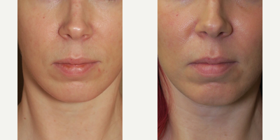 Woman treated with Cheek Augmentation - Woman treated with Cheek Augmentation