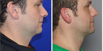 35-44 year old man treated with Kybella - 35-44 year old man treated with Kybella