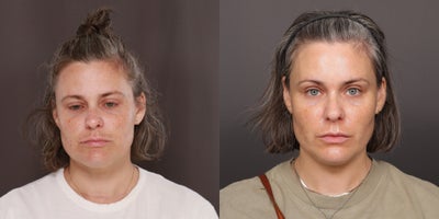 35-44 year old woman treated with Moxi Laser - Moxi Laser Treatments, 5 sessions with Katherine. 2 years post treatment, Age 39.