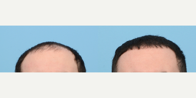 18-24 year old man treated with FUE Hair Transplant, Hair Transplant, Hair Loss Treatment, PRP for Hair Loss - This 23-year-old patient was looking to restore hair in the front and crown areas of his scalp. To do so, Dr. Wise performed an FUE hair transplant. During the procedure, 3,040 grafts were placed in zones 1 and 2, and a treatment of Platelet Rich Plasma therapy was done to strengthen the follicles. The results are shown one year post-op.