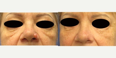 55-64 year old woman treated with Mohs Surgery, Mole Removal, Skin Rejuvenation - 59-year-old female before and 1 year after dermatologist Mohs removal of left nasal alar BCC (basal cell carcinoma) and reconstruction with a nasolabial flap. Surgery took 19 minutes in the office under local anesthesia. Patient started using Dr. Sperons Natural Skin Care Natural Scar Support Treatment 2 weeks after reconstruction.