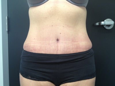 Tummy Tuck - Skin Only, No Muscle Repair, No Liposuction ...
