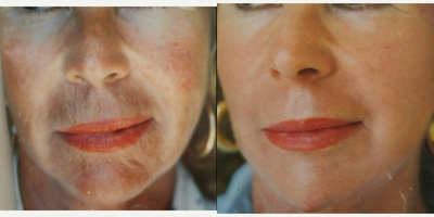 65-74 year old woman treated with CO2 Laser - 63 year old with facial aging and wrinkling treated with J-Plasma.
