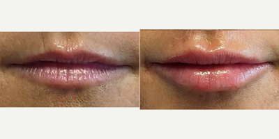 35-44 year old woman treated with Lip Fillers, Juvederm, Voluma, Vollure, Volbella, Restylane Kysse, Belotero - Lip augmentation with hyaluronic acid filler (Juvederm, Vollure, Volbella, Voluma, Restylane or Belotero) for balanced natural look & pout