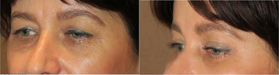 Woman treated with Brow Lift - Woman treated with Brow Lift