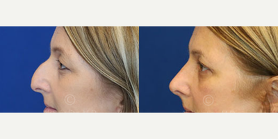 Woman treated with Eyelid Surgery - Eyelid Surgery