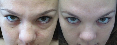 25-34 year old woman treated with Lower Lid Blepharoplasty - You can see in the head tilt photo that her excess lower eye fat has been removed.You do not want to take too much fat so that you hollow the patient and end up again them.If you take too little fat, the patient still has a break in transition between the lower eyelid and the midface.You need to take just enough to achieve balance in the final result.