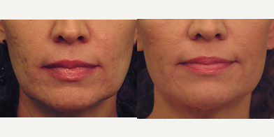 45-54 year old woman treated with Non Surgical Face Lift - Skin Tightening