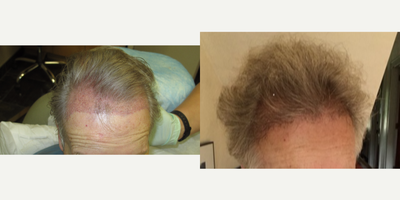 55-64 year old woman treated with Hair Transplant - Neograft 1500 units