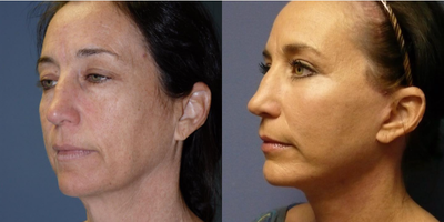 Woman treated with Eyelid Surgery - Woman treated with Extended SMAS Facelift as well as Neck Lift, Eyelid Surgery through upper blepharoplasty, and Facial Fat Transfer. Post-op, patient had an improved neck, jowls and cheek without any stigmata of a facelift.