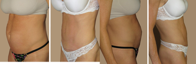 Abdominoplasty tummy tuck procedure repair diasthasis recti - Abdominoplasty tummy tuck with the correction of severe diasthasis recti