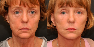 Woman treated with Mini Lift - Mini Facelift