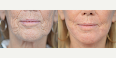 55-64 year old woman treated with Dermabrasion - This patient was concerned with the lines and wrinkles around her mouth. A perioral dermabrasion was performed to address her concerns.