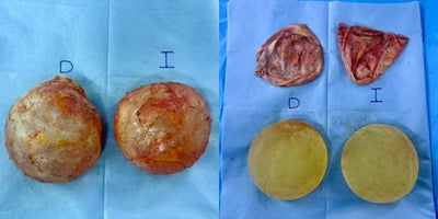 35-44 year old woman treated with Breast Implant Removal, Enbloc capCapsular Contracture Treatment - NBLOC T