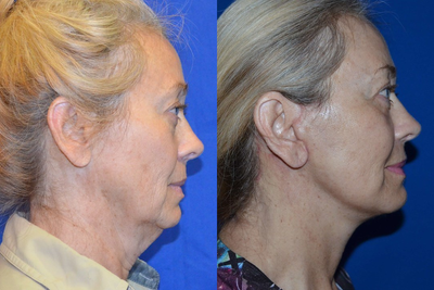 Woman in her 60s treated with Chin Surgery - Woman in her 60s treated with Chin Surgery using jowl implant as well as laser resurfacing to rejuvenate her look