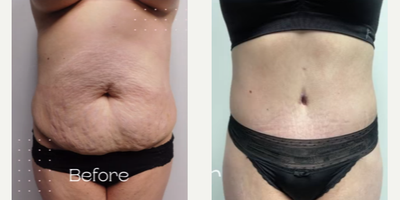 25-34 year old woman treated with Drainless Tummy Tuck - Let's talk drains...Until recently, when plastic surgeons performed a tummy tuck, we needed to place drains in the abdomen of every patient. Drains allow the fluid that accumulates following surgery to drain from the body. These drains stay in place for 2-3 weeks. They can be cumbersome, annoying, and, occasionally, uncomfortable. Why does fluid develop following an abdominoplasty? The process of rejuvenating the abdomen leaves a space between the surface tissues and the deeper tissues of the abdomen that takes a couple of weeks to heal. Fluids that naturally develop as your tissues heal move down and collect in the lower abdomen. Your lymphatic system cannot remove the fluid quickly enough, so drains are put in place to aid your body. The Drainless Tummy Tuck technique helps seal the top tissues to the deeper tissues so that there is no space for fluid collection. In short, this technique prevents your lymphatic system from being overwhelmed. Your body will still produce fluid, but it can easily be eliminated by the lymph nodes so there is no need for drains.