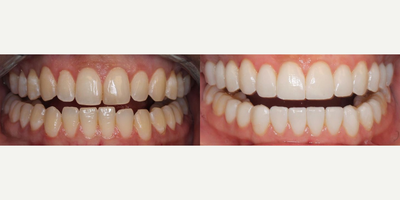Woman treated with Teeth Whitening - Woman treated with Teeth Whitening as well as 12 upper and lower porcelain veneers and changing the position and shape of the gums