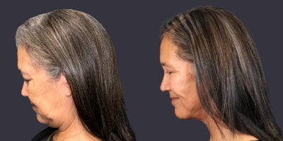 55-64 year old woman treated with Chemical Peel, Eyelid Surgery, Facelift, Lower Facelift, Neck Lift, TCA Peel, Velashape - 63 year old woman who is 5'3 tall and weighs 153 pounds. She had an upper eyelid lift, TCA chemical peel around the eyes, and a lower face and neck lift. Her after photos are at 6 months.