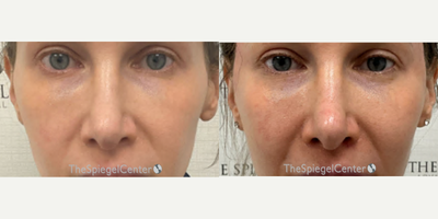 35-44 year old woman treated with Cheek Lift - 35-44 year old woman treated with Cheek Lift