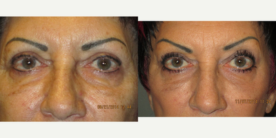 55-64 year old woman treated with Brow Lift - A lateral subcutaneous approach Brow Lift was performed on this woman seeking rejuvenation of here eyes. She previously had an upper blepharoplasty (upper eyelid procedure) performed, so a brow procedure was the perfect treatment to restore the brightness of her eyes without making her appear unnatural. Her recovery time was under one week and she reported nearly zero post-procedure discomfort. She additionally had a lower eyelid fractionated laser treatment performed simultaneously.