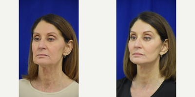 55-64 year old woman treated with Facelift, Buccal Fat Removal - facelift, lower blepharoplasty, buccal fat removal