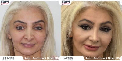 45-54 year old woman treated with Rhinoplasty, Facial Fat Transfer - 45-54 year old woman treated with Rhinoplasty, Facial Fat Transfer