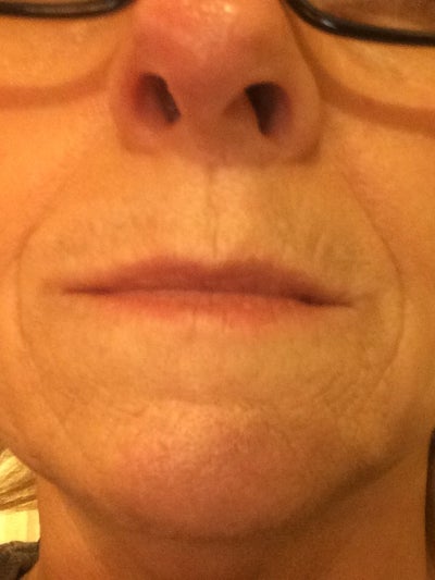 dark patch above upper lip