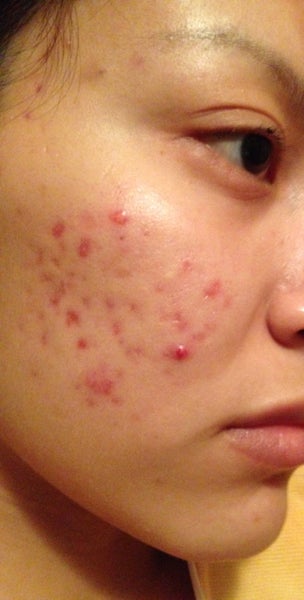 cystic-acne-and-acne-scars-how-to-cure-photo-doctor-answers-tips