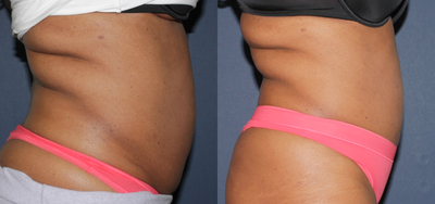 Before & After Liposonix - 	Patient undergoes liposonix to remove stubborn fat around the stomach and mid-section.
