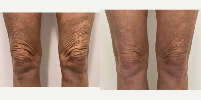 55-64 year old woman treated with Microneedling RF, Morpheus8 - The patient was self conscious of the crepey skin on her lower anterior thighs and the loose skin above her knees. I performed a series of Morpheus 8 Radiofrequency Microneedling treatments along with a biostimulatory injectable. The results are 8 months post treatment.