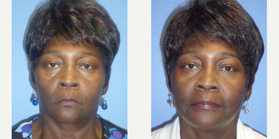 55-64 year old woman treated with Silhouette InstaLift - Dr. Edward Dickerson's Silhouette Instalift Non-Surgical Facelift patient.