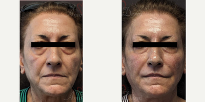55-64 year old woman treated with Liquid Facelift, Botox, Juvederm, Voluma, Vollure - Liquid Facelift with fillers in cheeks, nasolabial folds, marionette lines and Botox in neck lines (Juvederm, Voluma, Vollure, RHA)